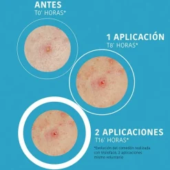 IROHA NATURE Hidratantes Faciales<Parches Sos Granos